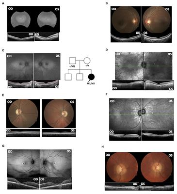 Identification of Deep-Intronic Splice Mutations in a Large Cohort of Patients With Inherited Retinal Diseases